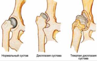 Артроз тазобедренного сустава: причины патологии, симптомы, лечение