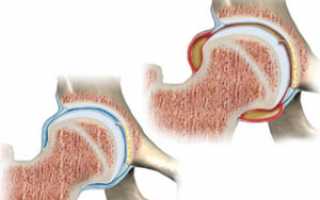 Синовит тазобедренного сустава: что это такое? Причины, лечение