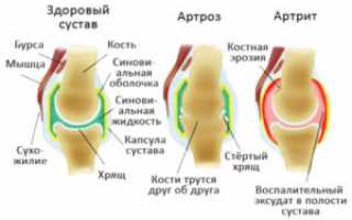 Артрит и артроз: в чем разница, профилактика и лечение