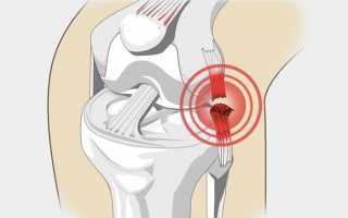 Разрыв связок коленного сустава: симптомы, диагностика, лечение